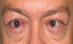 Thyroid Eye Disease