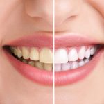 Methods of teeth whitening