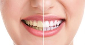 Methods of teeth whitening
