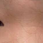 Do Epicanthal Folds Go Away?