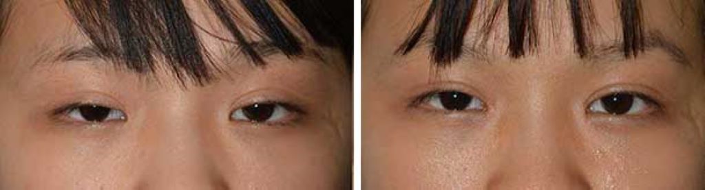 What Causes Epicanthal Folds?